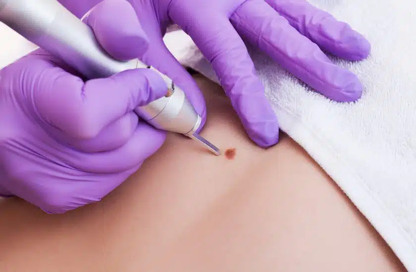 Лазерное удаление базалиом в Киеве
